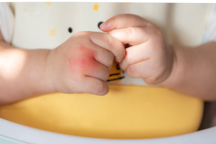 Nahaufnahme eines Babyarms mit einem roten, geschwollenen Mückenstich, der von einer Erwachsenenhand gehalten wird.