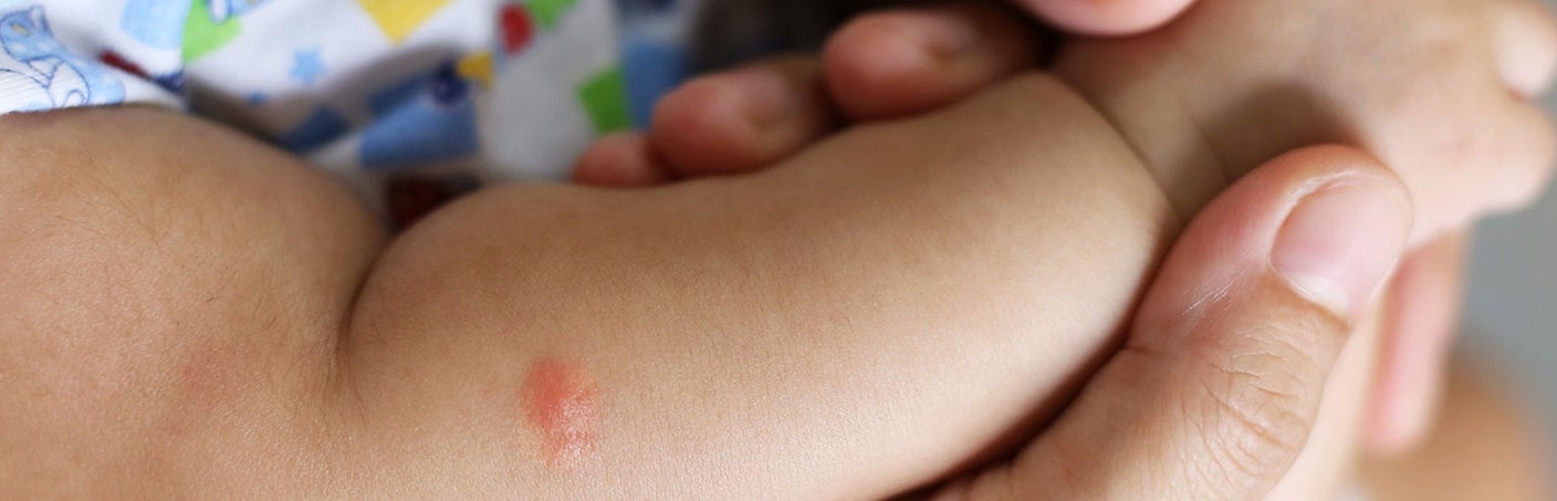 Nahaufnahme eines Babyarms mit einem roten Mückenstich, der von einer Erwachsenenhand gehalten wird.