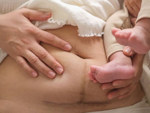 Eine Frau hält ihr Kind auf dem Arm. Dabei zieht sie ihren eigenen Bauch hoch und zeigt ihre Narbe vom Kaiserschnitt.