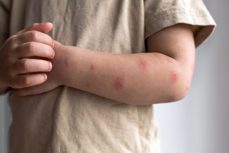 Gerötete und geschwollene Insektenstiche auf dem Unterarm eines kleinen Kindes im Kindergartenalter